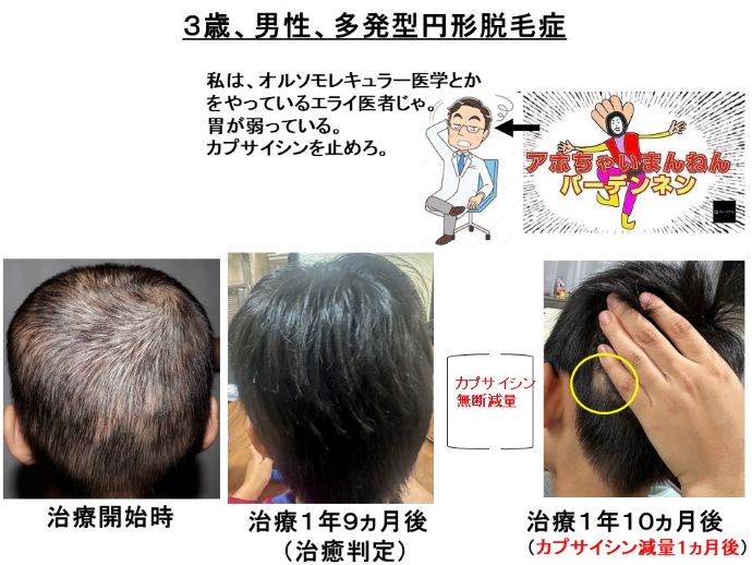 円形脱毛症　病院